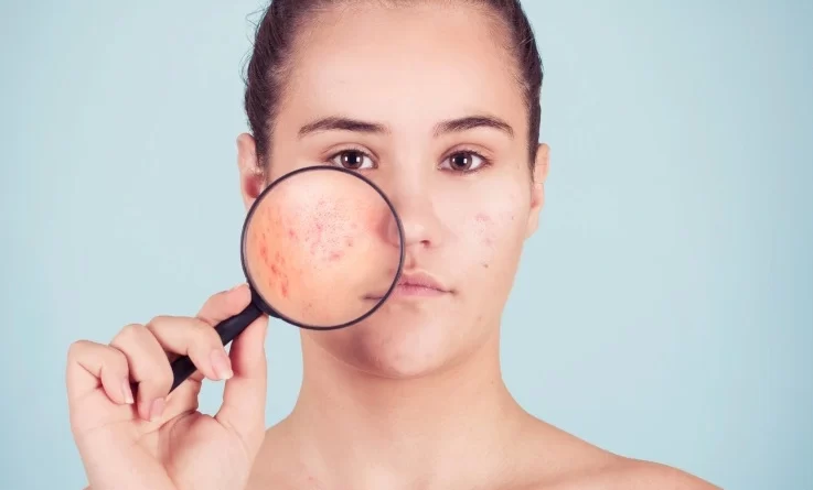 10-trucchi-anti-acne
